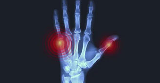 Small Bone Fracture